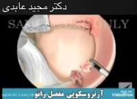 آرتروسکوپی مفصل زانو