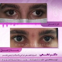 فیلم درمان انحراف چشم و کاهش دید در خانم 22 ساله