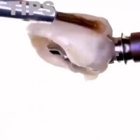 ایمپلنت دندان -دکترمجیدقیاسی دندانپزشک زیبایی مشهد