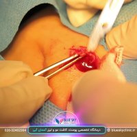 برداشت خال - 02632402304