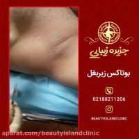 روش بوتاکس زیر بغل در کلینیک‌جزیره زیبائی