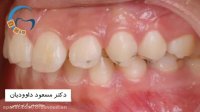 قبل و بعد ارتودنسی کاموفلاژ | دکتر مسعود داوودیان