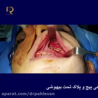 جراحی شکستگی گونه