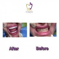 انجام کار زیبایی فک بالا و پایین