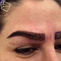 فیلم کاشت ابرو -کلینیک تخصصی رنسانس