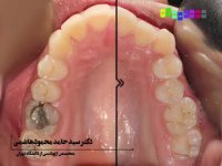 فیلم قبل و بعد از ارتودنسی