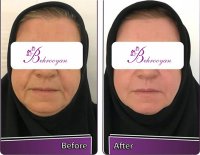 لیفت غبغب صورت با جدیدترین روش  اندولیفت