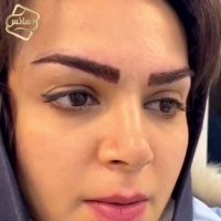 فیلم کاشت ابرو -کلینیک تخصصی رنسانس