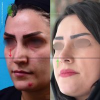 هشت ماه بعد از جراحی زیبایی بینی | دکتر باستانی نژاد