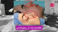 فیلم بلافاصله بعد از عمل بینی