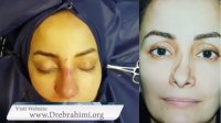 عمل ترمیم بینی با غضروف گوش توسط دکتر امید ابراهیمی بهترین جراح بینی