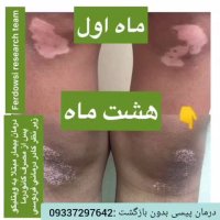 بیماران مبتلا پیسی ببینند