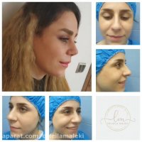 نتیجه جراحی بینی بعد از دوماه