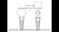 متخصص ایمپلنت دندان غرب تهران