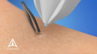 CryoConcepts - CryoClear Device - 3D Medical Animation