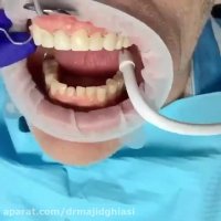 اصلاح طرح لبخند -دکترمجیدقیاسی دندانپزشک زیبایی مشهد