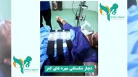 فیلم واقعی جراحی شکستگی مهره های کمر