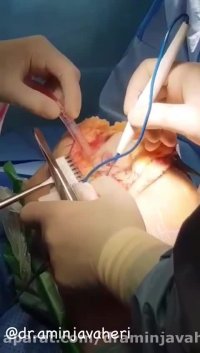 عمل جراحي تعويض مفصل زانو