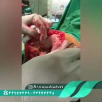 فیلم جراحی رباط صلیبی و منیسک