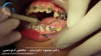 ارتودنسی دندان روکش شده | دکتر مسعود داوودیان
