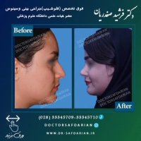 نمونه جراحی های بینی دکتر فرشید صفدریان