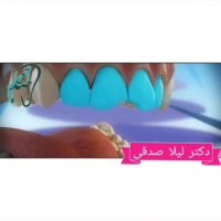 لمینت دندان