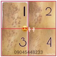 کشف درمان قطعی زگیل تناسلی !!