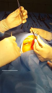 جراحی بینی باز دکتر نسرین راستا 09337174804