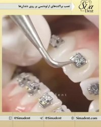نصب براکت های ارتودنسی | دندانپزشکی سیمادنت