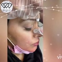 فیلم واقعی فرم‌دهی بینی بدون جراحی و با تزریق ژل