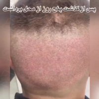 فیلم کاشت مو_کلینیک تخصصی رنسانس