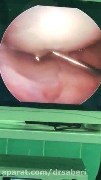 عوارض عدم درمان زانوی پرانتزی