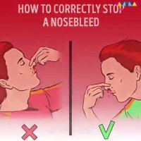 چگونه بطور صحیح خونریزی بینی را بند بیاوریم؟(مهم)