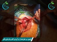 تعویض مفصل در لگن