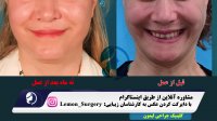 آیا دوست دارید با جراحی لیفت 10 الی 15 سال نسبت به همسن و سالهای خود  جوانتر شوید ؟