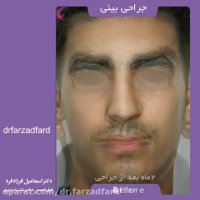 جراحی زیبایی بینی توسط دکتر فرزاد فرد