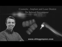 کاشت دو واحد ایمپلنت