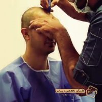 کاشت مو رنسانس- سوپر کاشت کلینیک تخصصی رنسانس