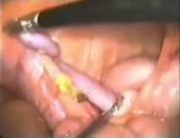 جراحی آپاندکتومی