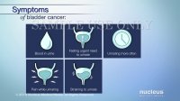 تشخیص درمان سرطان مثانه با انیمیشن