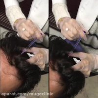 مزوتراپی مو