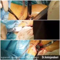 مراحل جراحی تعویض مفصل لگن