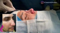 فیلم جراحی بینی گوشتی با پوستی بسیار ضخیم