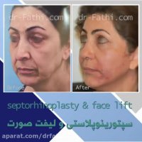 نمونه کار جراحی لیفت صورت