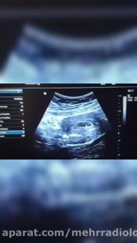 فیلم تشکیل ساک حاملگی