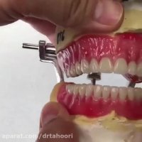 دست دندان مصنوعی-مرکز فوق تخصصی ایمپلنت پردیس www.pardisdental.ir