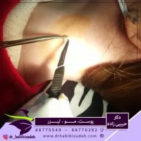 فیلم برداشتن خال گوشتی گردن