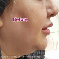 فیلم قبل و بعد رفع افتادگی غبغب با هایفوتراپی