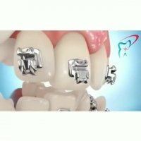 ارتودنسی دندان چگونه انجام میشود؟