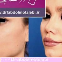 جراحی زیبایی بینی